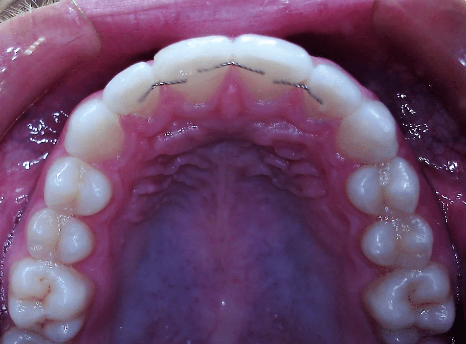 Teeth Straightening - Lingual Braces - Orthodontics PA